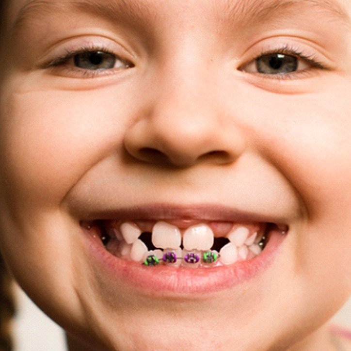 smiling girl who knows what dental sealants in Long Beach are